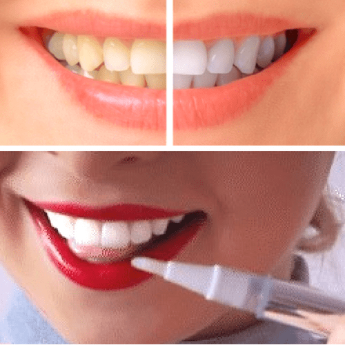 Whitening Pen